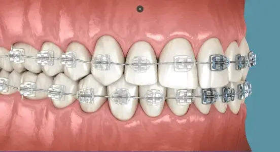 Aparat dentar ceramic Timișoara