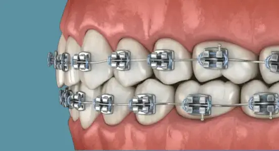 Aparat dentar metalic Timișoara