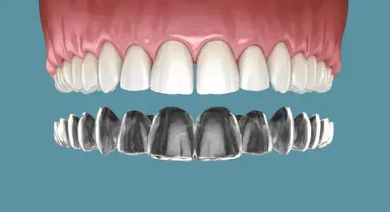 Aparat dentar Spark Timișoara