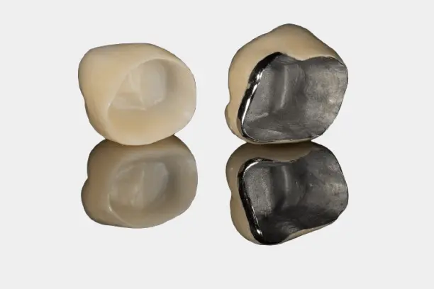 Coroana zirconiu ceramică vs coroana metalo-ceramică - Timișoara