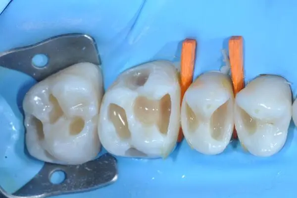 Cabinet Stomatologic Timișoara Obturație Dentară