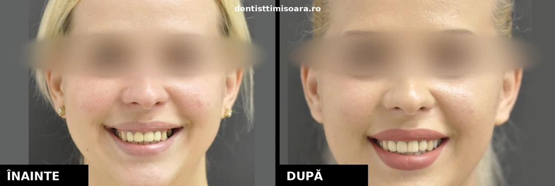 Restaurare protetică grup frontal și lateral superior Timișoara - înainte și după
