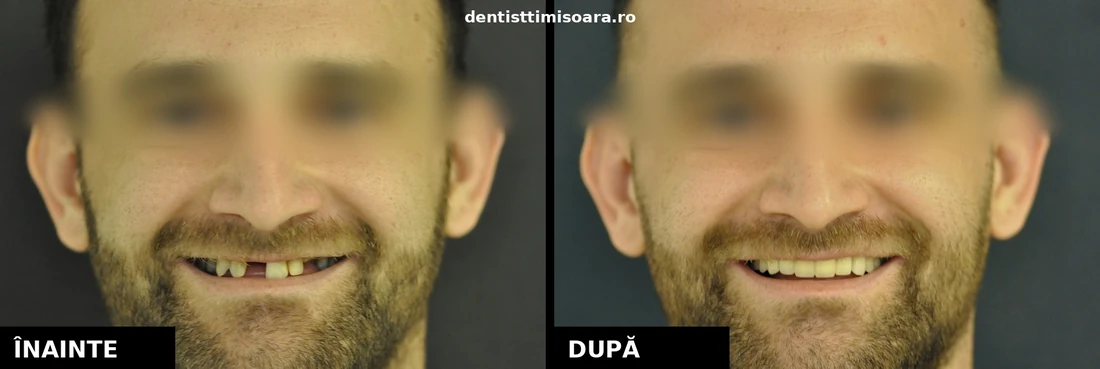 Lucrare protetică metalo-ceramică 13 elemente Timișoara - înainte și după