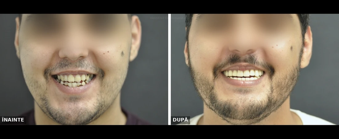 Reabilitare orală completă bimaxilară Timișoara - înainte și după