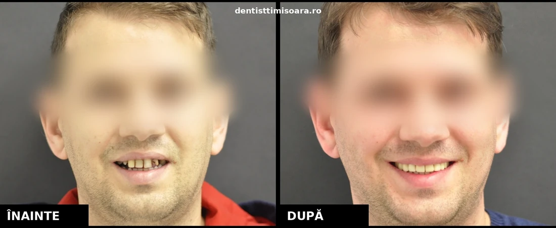 Reabilitare protetică completă arcadă superioară Timișoara - înainte și după