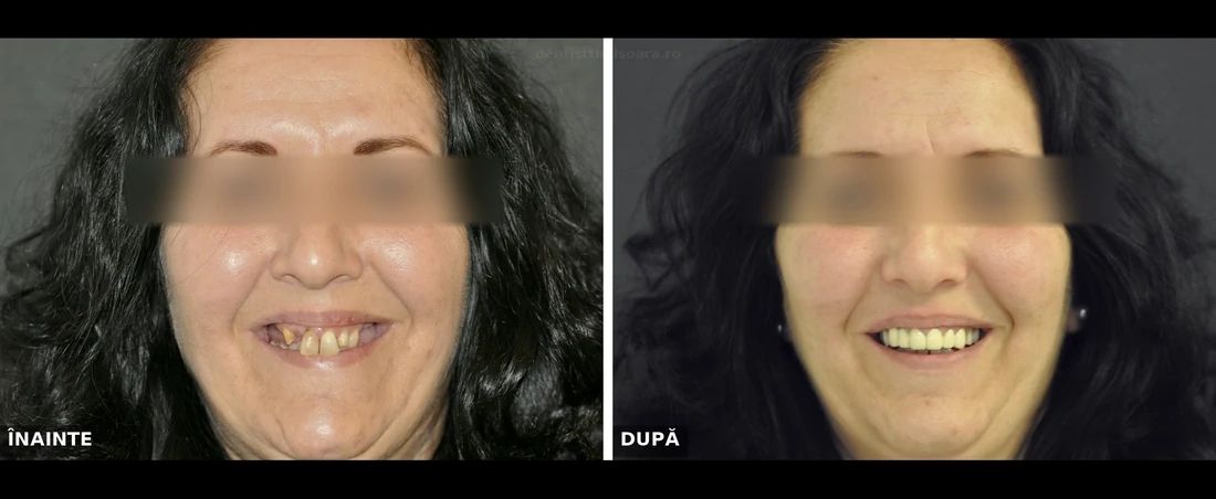 Reabilitare protetică mixtă coroane fixe și proteză mobilizabilă Timișoara - înainte și după
