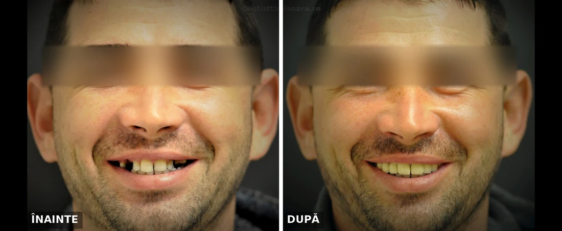 Reabilitare protetică arcadă superioară cu extracții multiple Timișoara - înainte și după