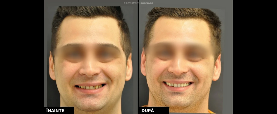 Restaurare estetică frontală fracturi coronare Timișoara - înainte și după