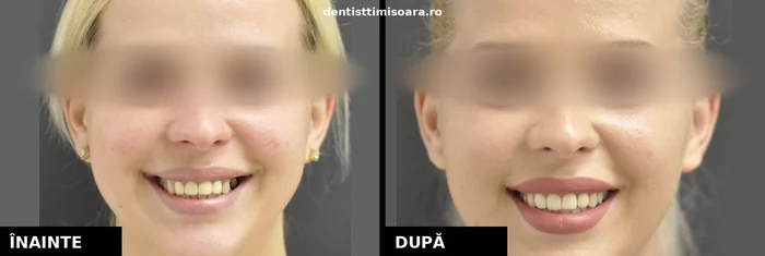 Restaurare protetică grup frontal și lateral superior Timișoara - înainte și după