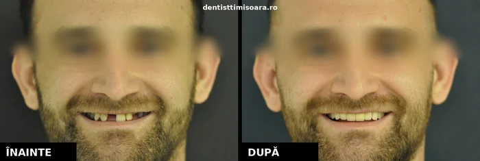 Lucrare protetică metalo-ceramică 13 elemente Timișoara - înainte și după