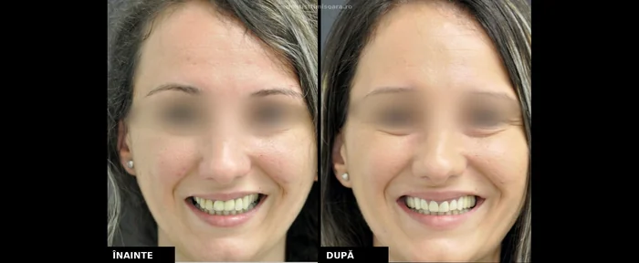 Lucrare protetică zirconiu-ceramică arcada superioară Timișoara - înainte și după