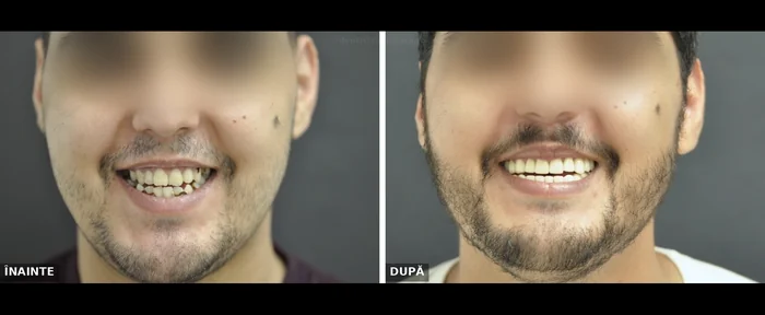 Reabilitare orală completă bimaxilară Timișoara - înainte și după