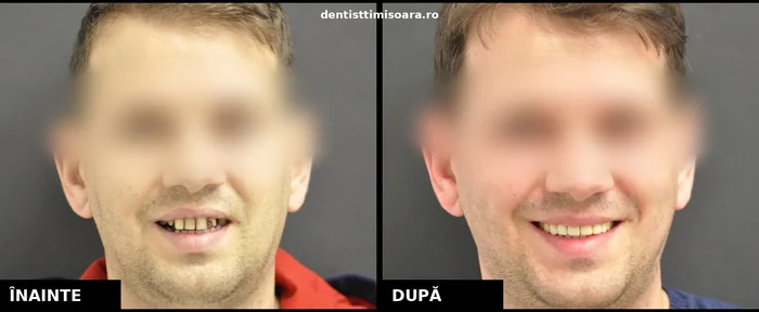Reabilitare protetică completă arcadă superioară Timișoara - înainte și după