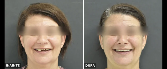 Reabilitare protetică arcadă superioară Timișoara - înainte și după