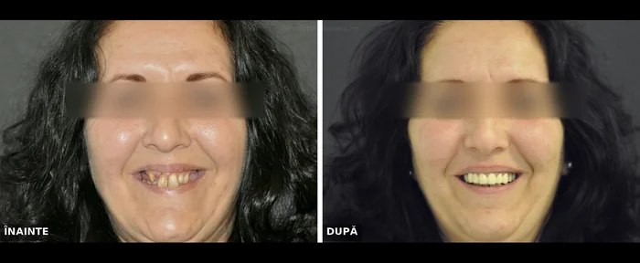 Reabilitare protetică mixtă coroane fixe și proteză mobilizabilă Timișoara - înainte și după