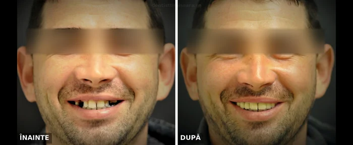 Reabilitare protetică superioară cu extracții multiple Timișoara - înainte și după