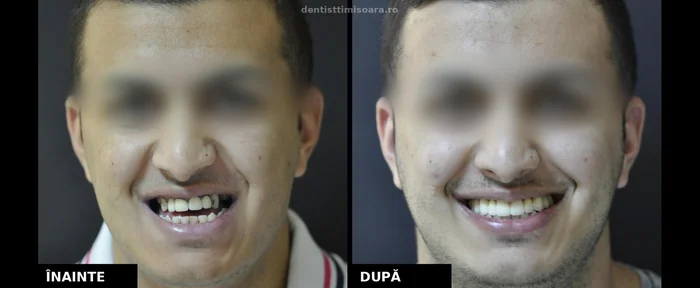 Lucrare zirconiu-ceramică Timișoara - înainte și după