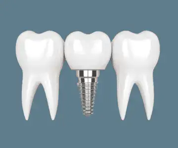 Implant Dentar Timișoara
