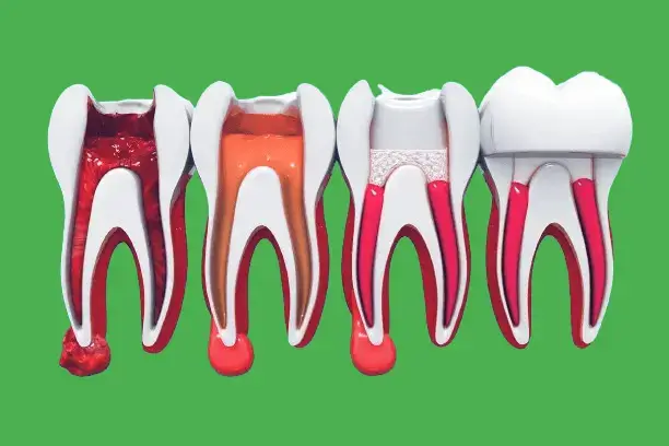 Tratament de canal Timisoara