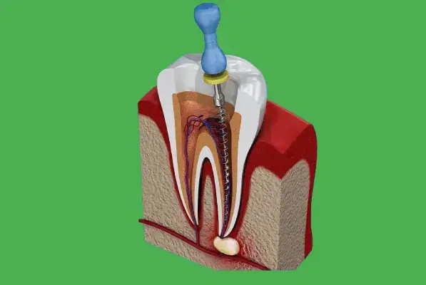 Re-tratament endodontic Timisoara