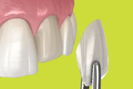 Fațete Dentare Timișoara