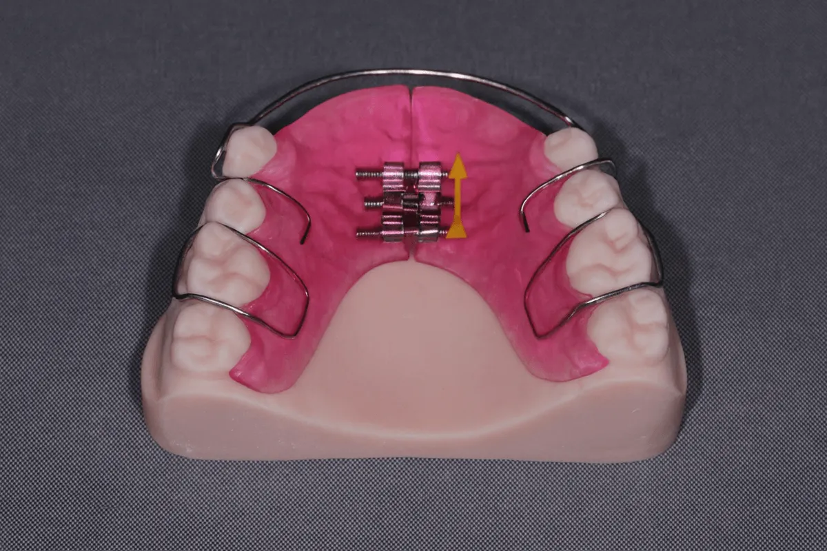 Aparat dentar mobil Timisoara