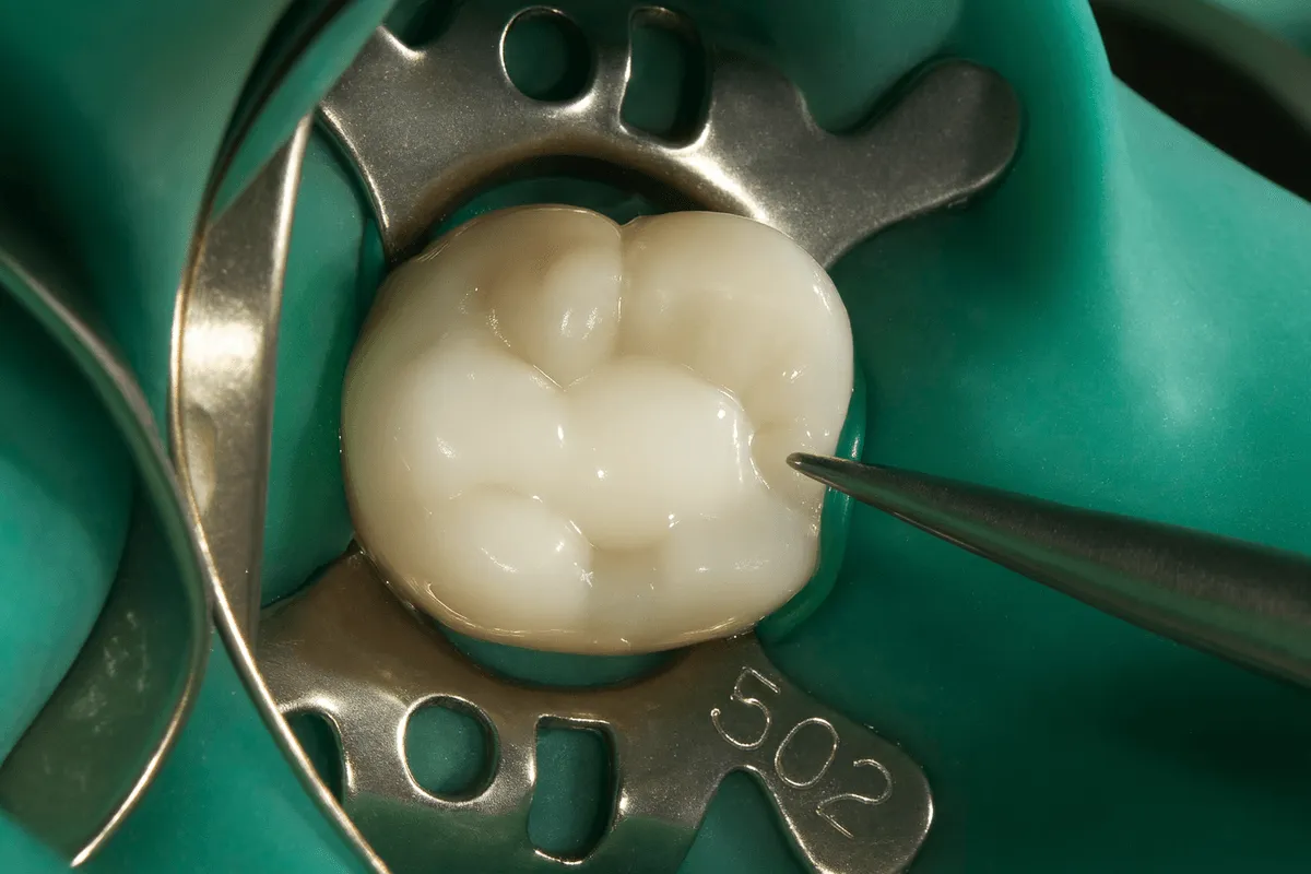 Obturatie Compozit Timisoara