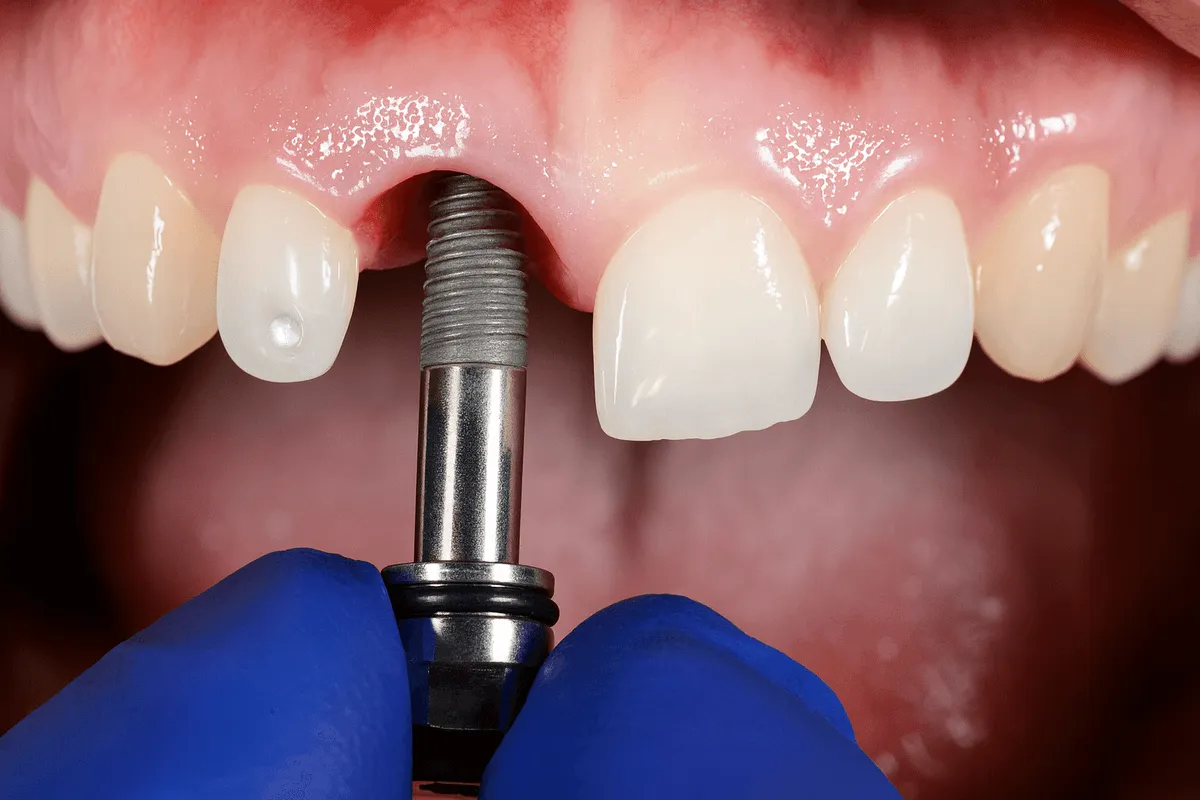 Pret Implant Dentar Timisoara