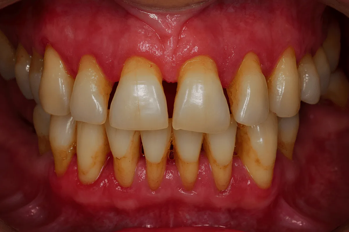 Tratament parodontoza Timsioara parodontita